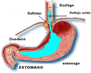 Reflujo Gastro esofÃgico