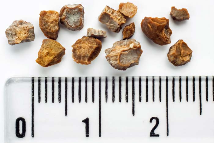 blog kidney stones