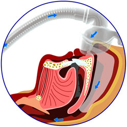 cpap treatment