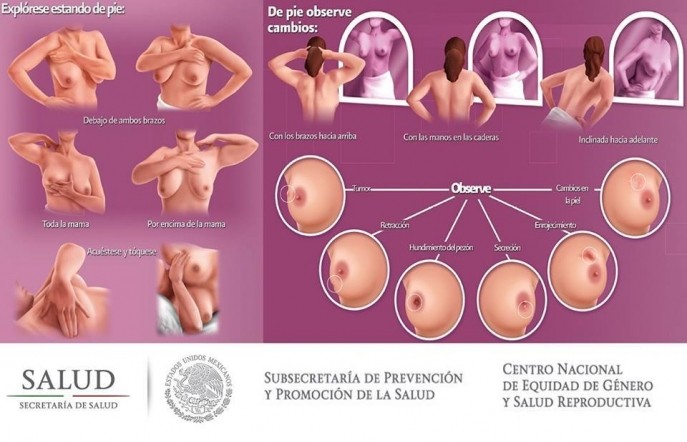 Cancer de mama
