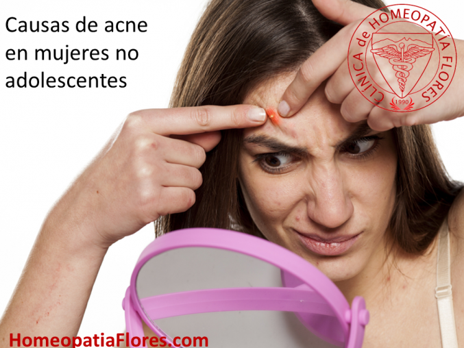 Causas de acne cuando la adolescencia ha quedado atras