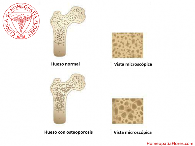 ¿Que ocasiona osteoporosis?