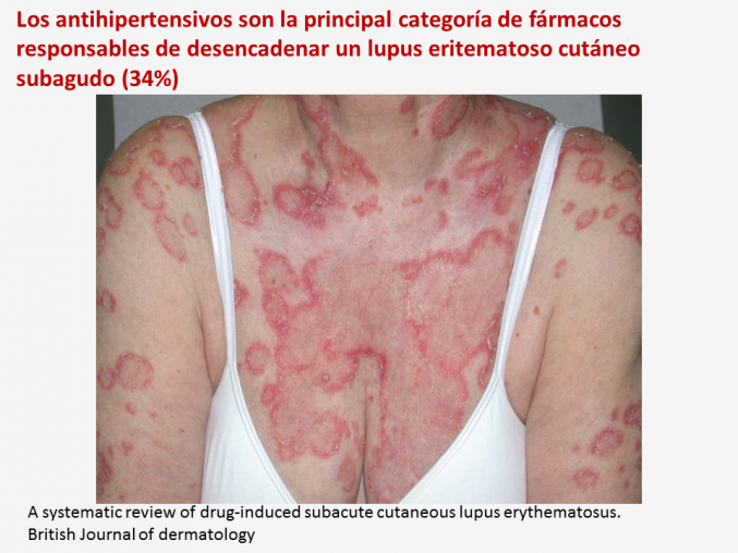 Entre 25% y 30% de los nuevos diagnósticos de lupus eritematoso cutáneo subagudo podrían ser causados por fármacos