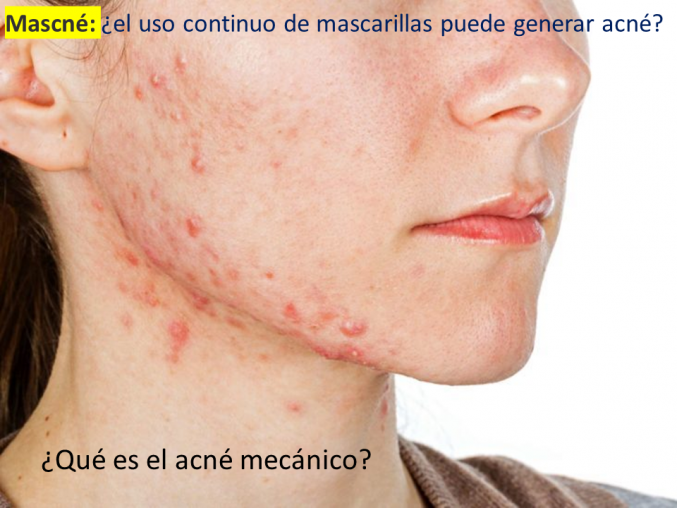Uso de cubrebocas y acné.
