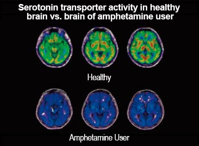 Las anfetaminas y el cerebro