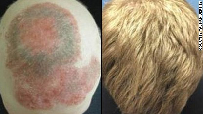 Una esperanza para quienes sufren de alopecia areata.