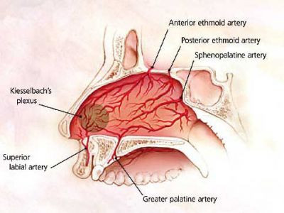 Los sangrados nasales