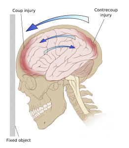 b2ap3_thumbnail_TBI.png