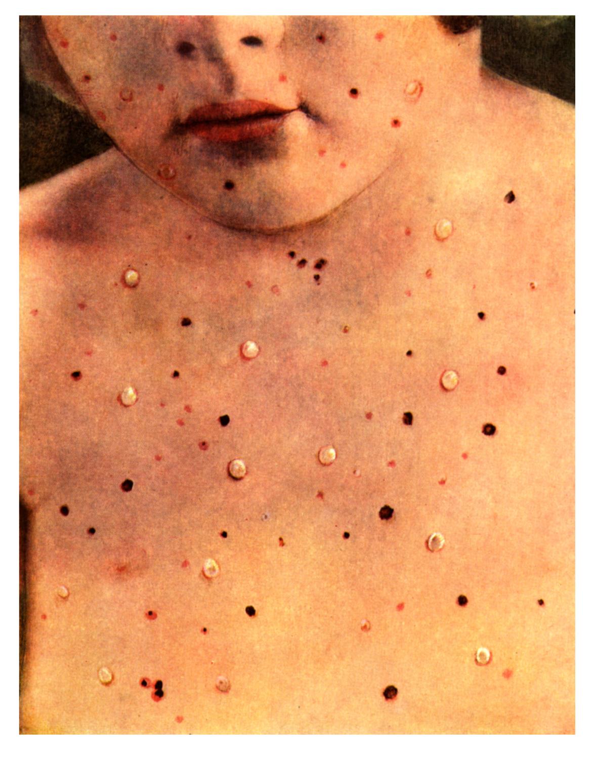 varicella